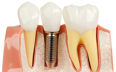 Implant Dentistry